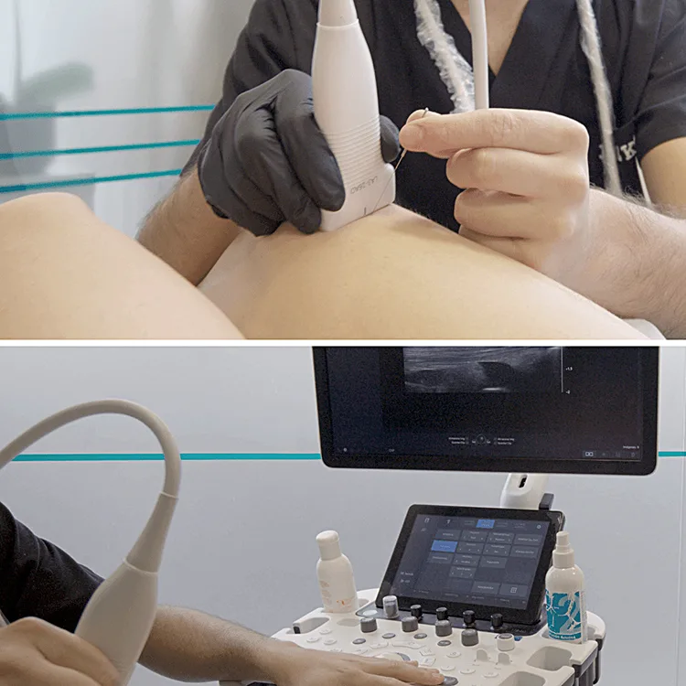 Punción seca ecoguiada